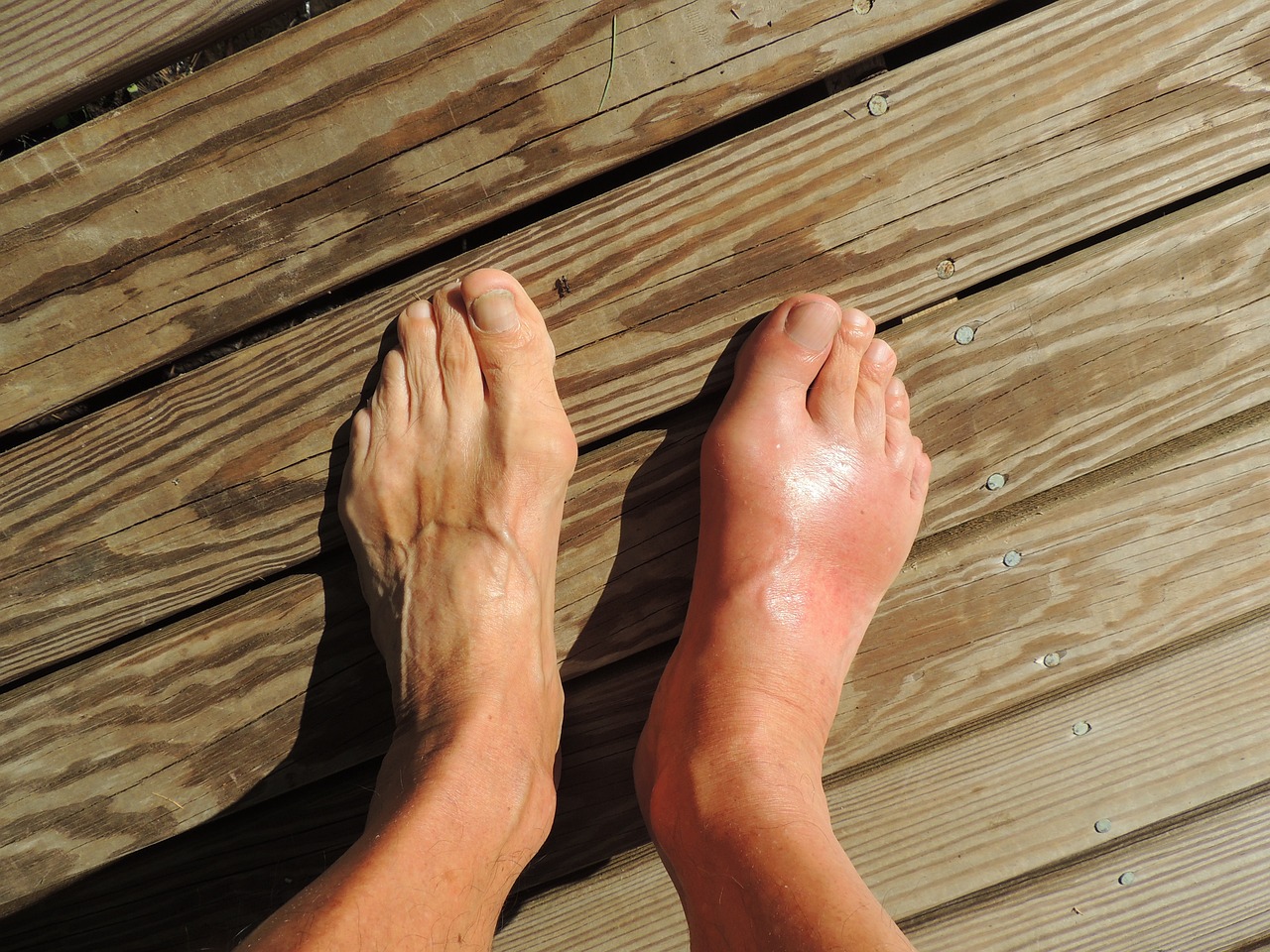 7 Easy Ways to Get Rid of Gout