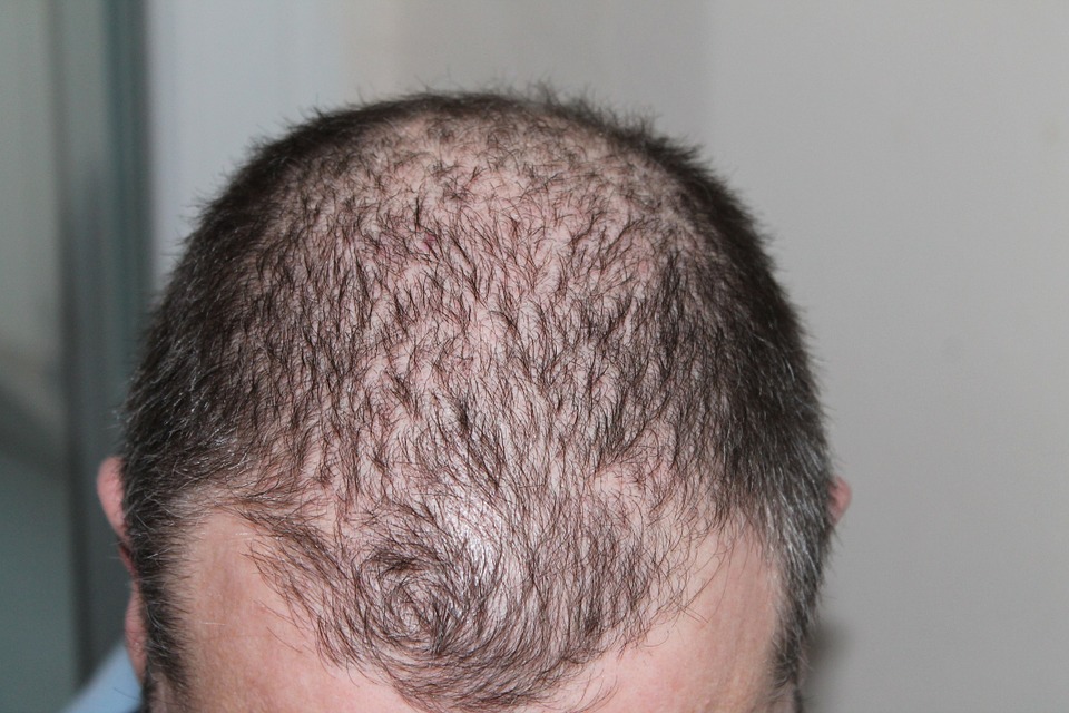 A Proven Treatment For Hair Loss